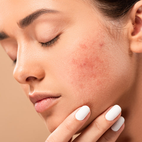 Understanding Acne as a Chronic Disease
