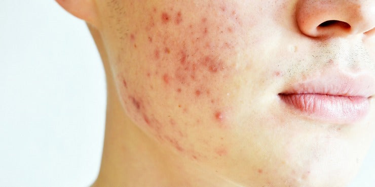 Acne and Inflammation
