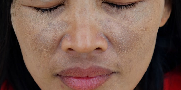 The Many Different Causes for the Pigmentation Known as Melasma