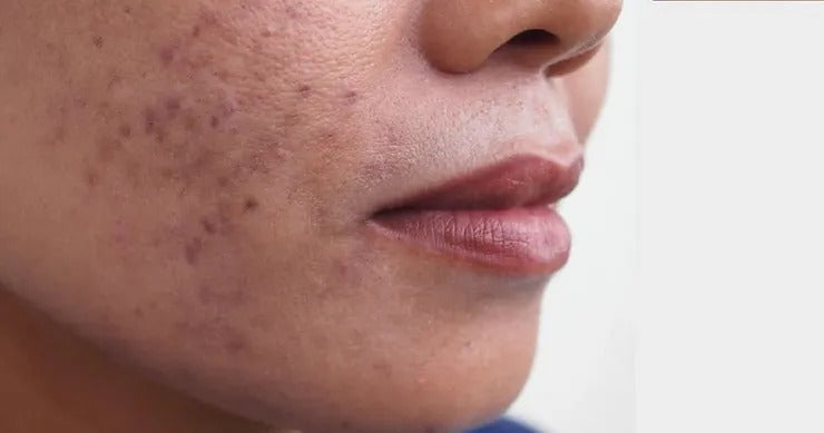 Post-Inflammatory Hyperpigmentation is the Most Common Cause of Hyperpigmentation