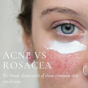 Acne VS Rosacea: The Truth Your Clients Need You To Know (E-book)